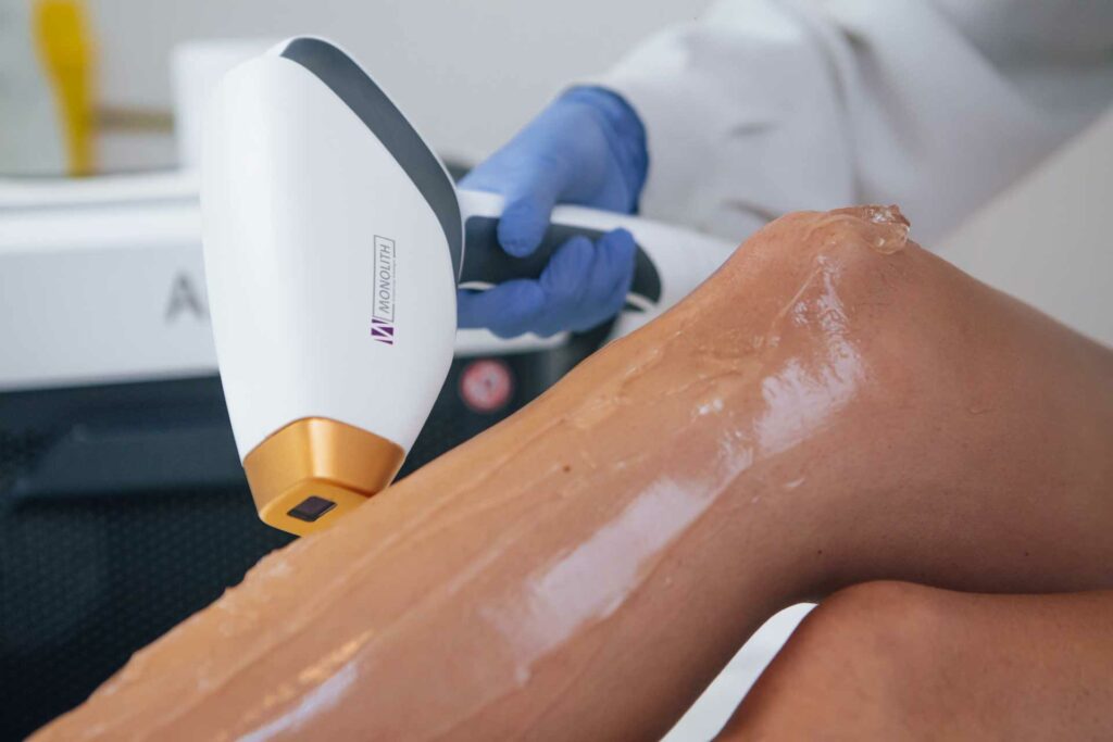 Dauerhafte Haarentfernung mit dem Diodenlaser am Bein bei Flair Kosmetik